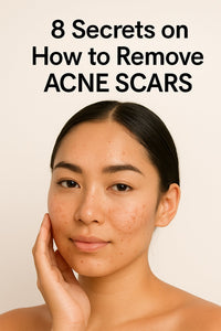 8 Secrets on How to Remove Acne Scars